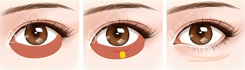 激光祛眼袋术过程 激光祛眼袋术过程