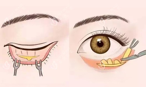 内外祛眼袋切口对比展示 内外祛眼袋切口对比展示