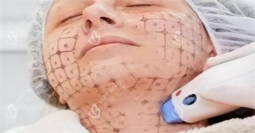 热玛吉中下面部设计点位图 热玛吉中下面部设计点位图