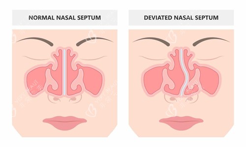 鼻修复手术前后对比