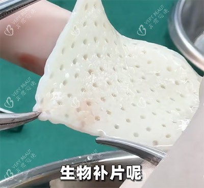 生物补片改善增大增粗照片