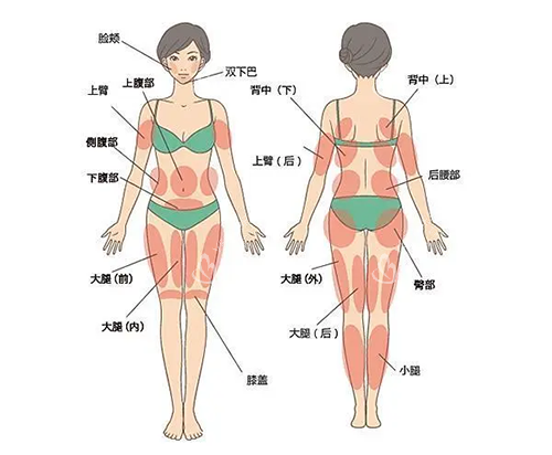 吸脂身体部位图片 吸脂身体部位图片