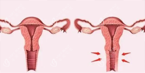 3D生物束带紧缩术对比图 3D生物束带紧缩术对比图