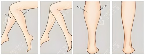 腿部吸脂手术前后对比动画图 腿部吸脂手术前后对比动画图