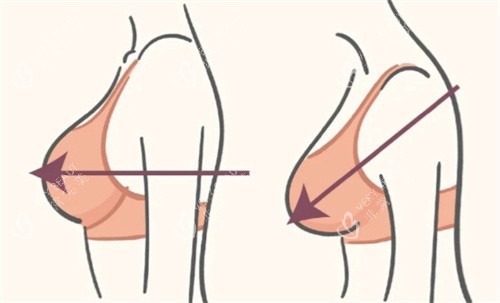 缩胸手术术前术后