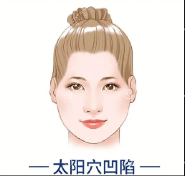 太阳穴凹陷 太阳穴凹陷