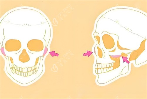 颧骨手术磨骨部位骨头演示动画图