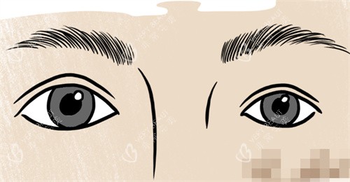 双眼皮大小眼修复