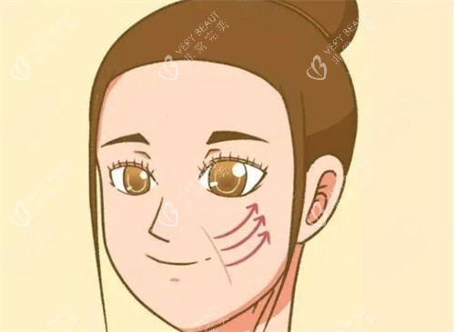 拉皮手术图片 拉皮手术图片