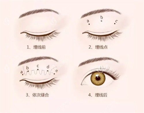 双眼皮埋线过程图 双眼皮埋线过程图
