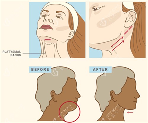 面部提升改善下颌