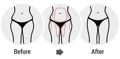 腰腹大腿吸脂前后对比图 腰腹大腿吸脂前后对比图