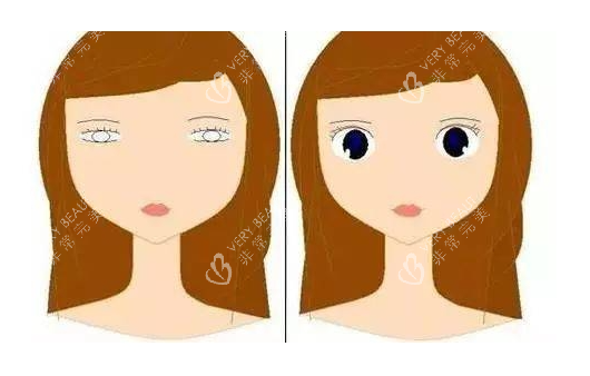 眼皮松弛做双眼皮对比图 眼皮松弛做双眼皮对比图