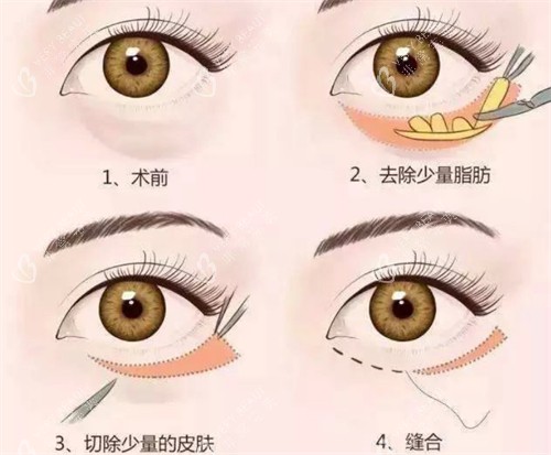 外切祛眼袋手术过程 外切祛眼袋手术过程