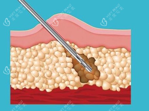 吸脂针图片 吸脂针图片