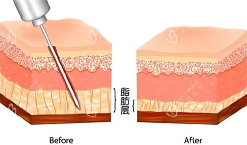吸脂手术脂肪层对比 吸脂手术脂肪层对比