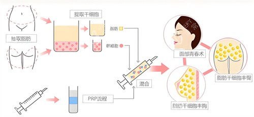 自体脂肪隆胸过程