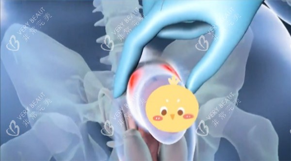 增大增粗手术照片