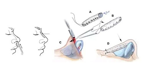 隆鼻手术方法图 隆鼻手术方法图