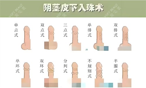 阴茎皮下入珠术图片