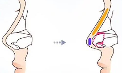 鼻小柱延长的前后对比图