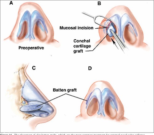 修复畸形的鼻子