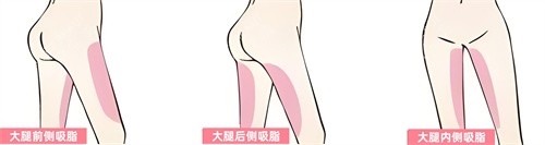 腿部吸脂部位展示动画图