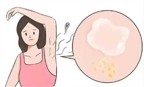 腋臭卡通图照片示意图