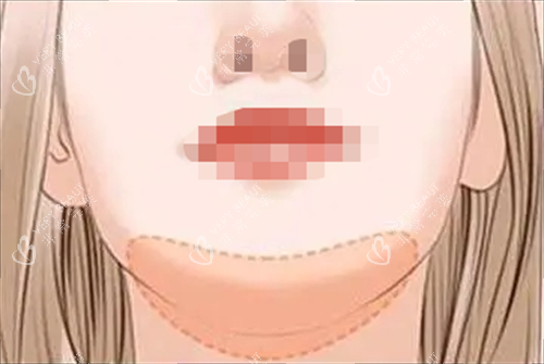 玻尿酸丰下巴部位示意图 玻尿酸丰下巴部位示意图