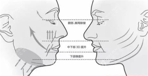 面部提升前后各个部位的对比
