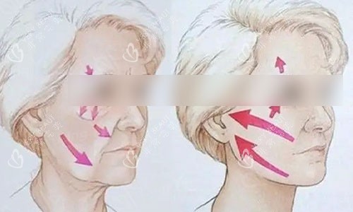 做拉皮手术前后动画图 做拉皮手术前后动画图