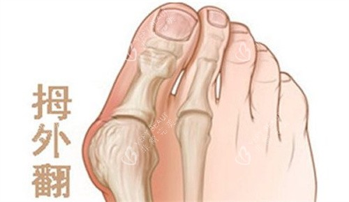 拇外翻