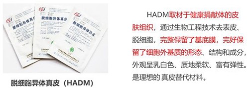 3d生物束带紧缩术材料示意图