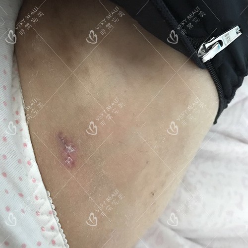 大腿吸脂伤口