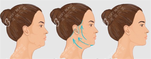 面部提升改善皮肤状态