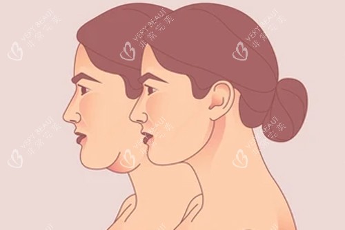 颈部拉皮变成天鹅颈