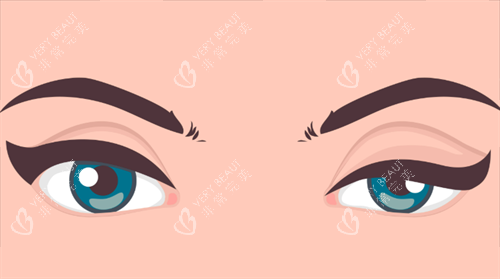 上睑下垂 上睑下垂