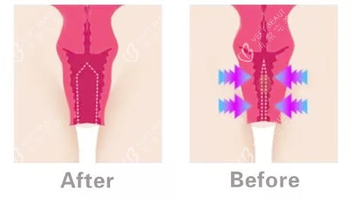 阴道紧缩对比图