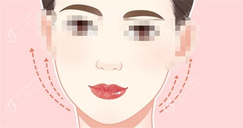 拉皮手术后面部提拉示意图.jpg