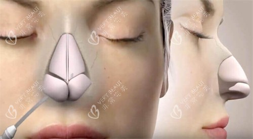 隆鼻手术动画图