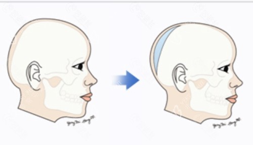 骨水泥填充后脑勺 骨水泥填充后脑勺