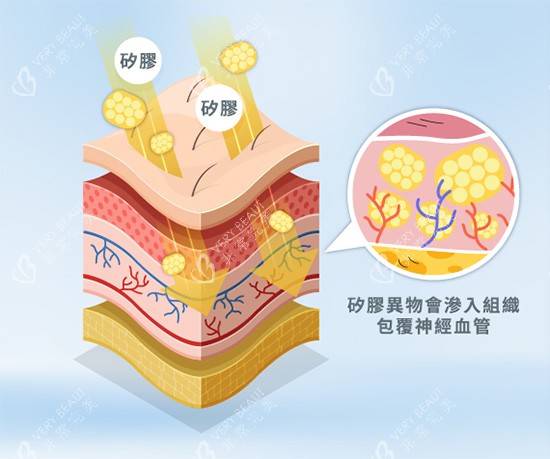 馒化针注射示意图
