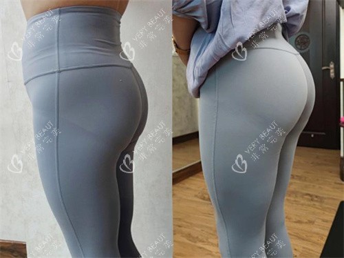 臀部吸脂手术侧面对比图