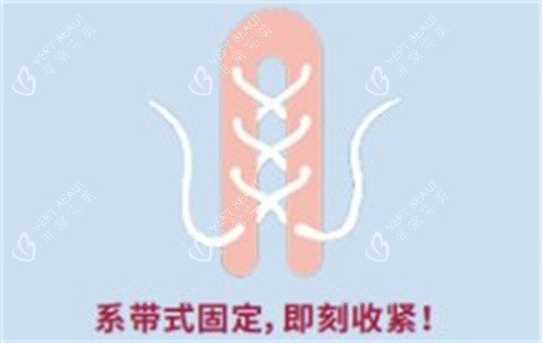 再生阴道紧缩术