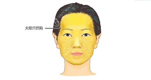 太阳穴凹陷演示动画图 太阳穴凹陷演示动画图