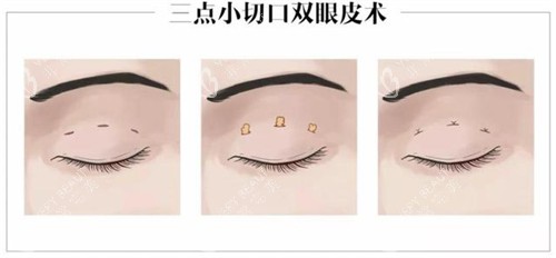 三点定位双眼皮的操作步骤 三点定位双眼皮的操作步骤