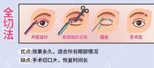 双眼皮手术全切法动画演示图