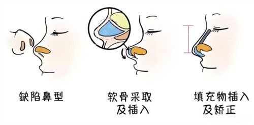 鼻综合手术过程动画