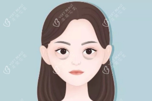 眼袋卡通图展示 眼袋卡通图展示