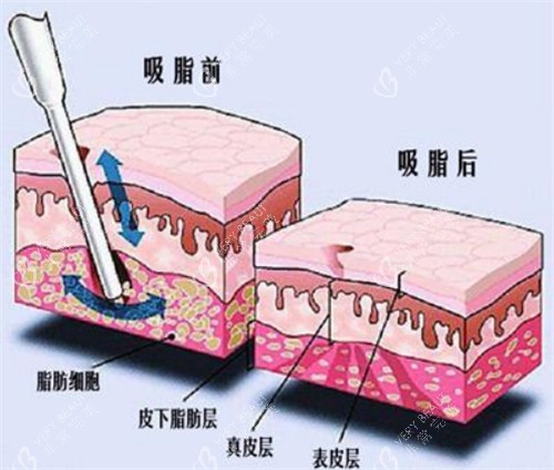 吸脂手术前后对比动画图示 吸脂手术前后对比动画图示